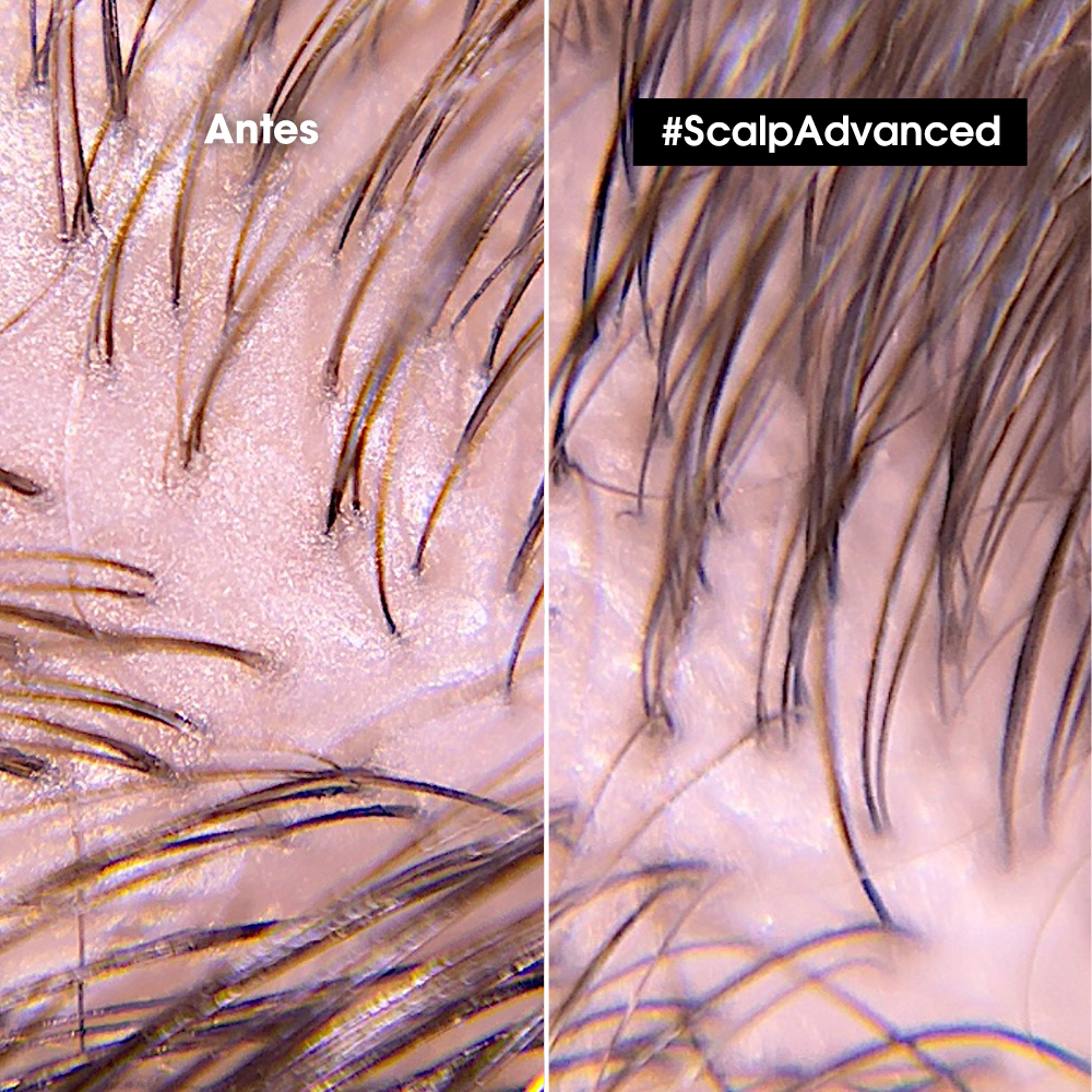 L’Oréal Professionnel Scalp Advanced | Shampoo Anti Grasa 300ml Limpieza Purificante y Control de Sebo