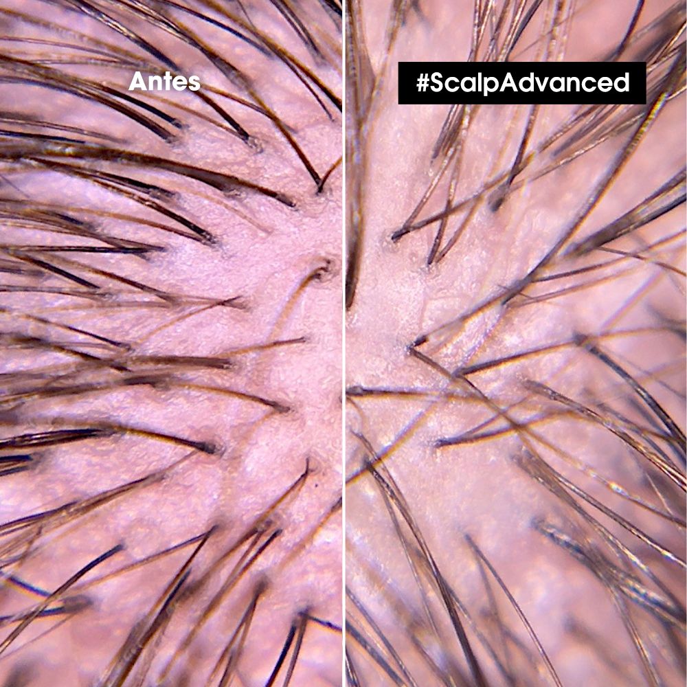 L’Oréal Professionnel Scalp Advanced | Shampoo Anti Malestar 300ml Calma y Confort para Cuero Cabelludo Sensible