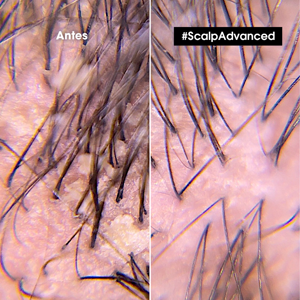 L’Oréal Professionnel Scalp Advanced | Shampoo Anticaspa 300ml Limpieza Purificante y Equilibrio del Cuero Cabelludo